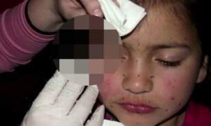 O mamă denaturată și-a mutilat copila! Îi injectează botox în față, dintr-un motiv halucinant