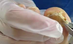 Video şocant / Năucitor ce se poate afla sub o unghie bolnavă! Imaginile au ajuns virale