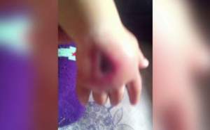 Caz şocant! Un copil de numai 9 luni s-a ales cu o gaură în mână din cauze unei branule!
