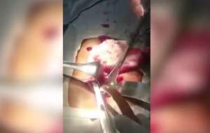 VIDEO / Un bărbat a mers la spital cu dureri cumplite! Medicii au fost şocaţi când au văzut ce avea în stomac şi au filmat tot