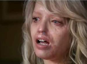Katie Piper, femeia desfigurată cu acid pe stradă, operată pentru a 400-a oară! Mesajul transmis de prezentatoarea tv: „Inima mea nu va renunța” / FOTO
