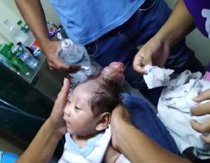 FOTO / Halucinant! Un bebeluș s-a născut cu un "corn" pe mijlocul capului