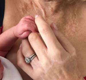FOTO / Katie Piper, tânăra mutilată cu acid sulfuric, a născut! Prima imagine cu ea și bebelușul
