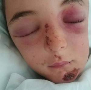 FOTO / Accidentul care a marcat PE VIAȚĂ un copil de 14 ani: a SURZIT cu o ureche. Mesajul mamei după incident
