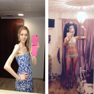 FOTO / Transformarea spectaculoasă a unei tinere anorexice! Cântărea 25 de kilograme, dar acum e campioană la fitness