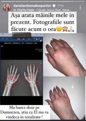 Cum arată mâinile Danei Roba în prezent, după ce make-up artista a fost mutilată de soțul ei. Vedeta le-a arătat fanilor fotografii recente / FOTO