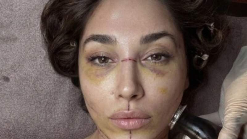 Influencer celebru în Romania, cu ochii vineți și fața tumefiată. Imagini incredibile