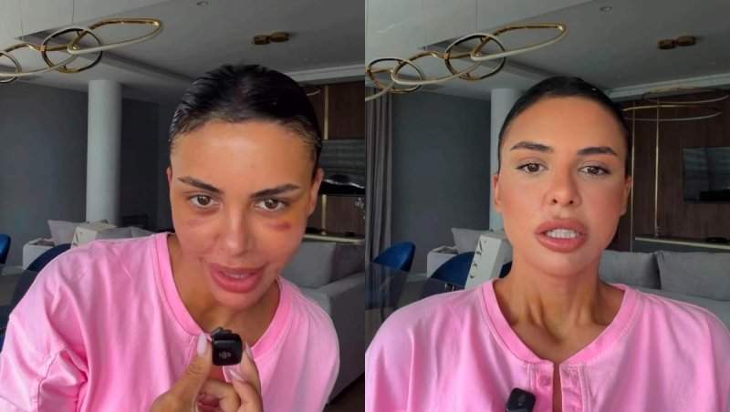 Andreea Popescu a spus exact ce intervenții estetice a făcut. Declarațiile sincere ale influenceriței