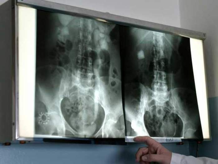 Descoperire macabră în trupul unei femei de 82 de ani! Medicii au rămas interzişi când au văzut radiografia!