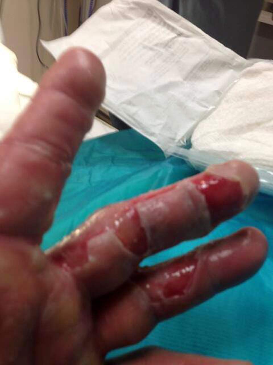 Dumnezeule, ce răni cumplite! Un star de la Hollywood şi-a distrus mâinile într-un accident: "Mi-a explodat un radiator" / Galerie foto şocantă