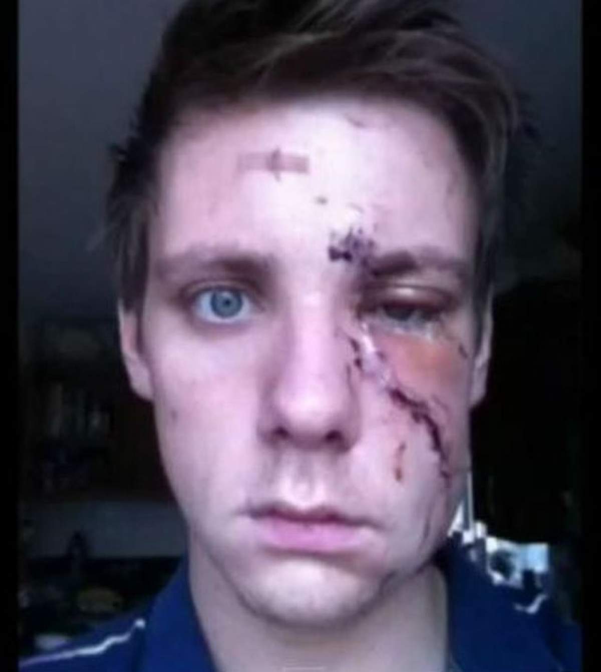 VIDEO / Alan Crowley, tânărul care a fost desfigurat în club, şi-a făcut un selfie în fiecare zi! Cum arată acum cicatricile