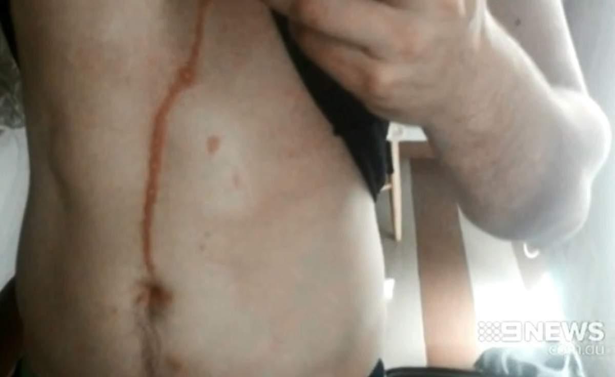 VIDEO/ Şi-a făcut o operaţie şi i-a intrat un păianjen pe sub piele! Ce a păţit bărbatul, în continuare, te va şoca