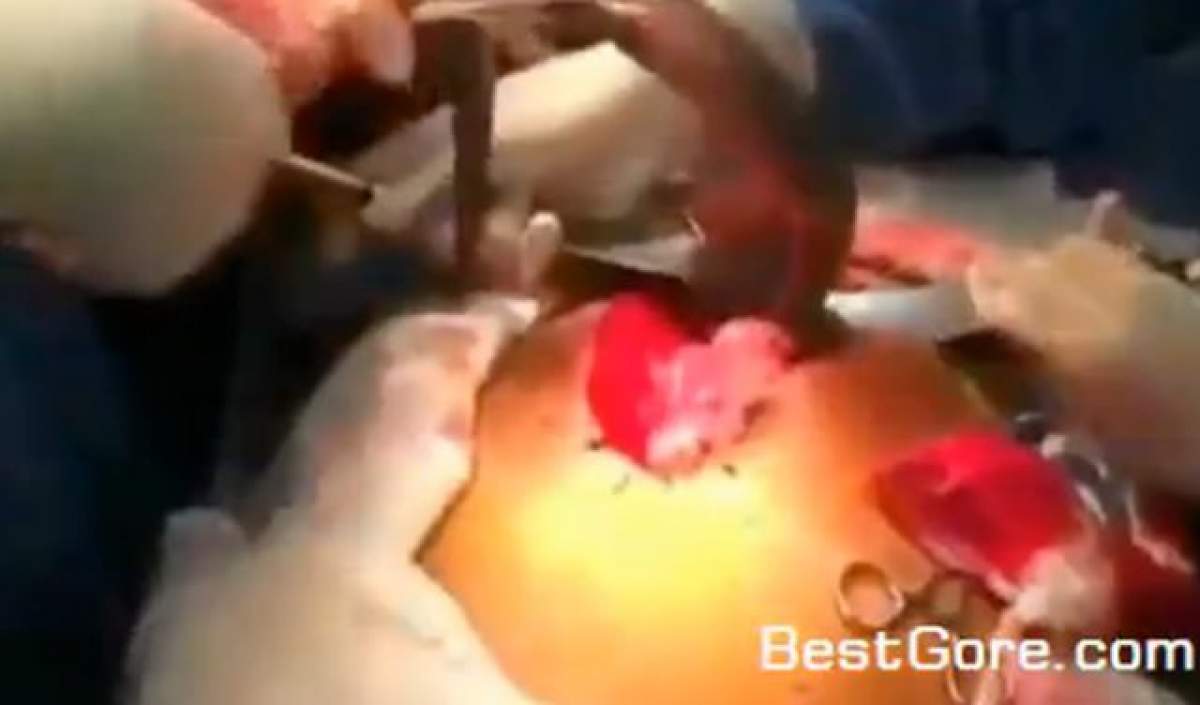 VIDEO/ Aşa ceva clar nu ai mai văzut! Un bărbat a ajuns la medici cu un peşte blocat în anus