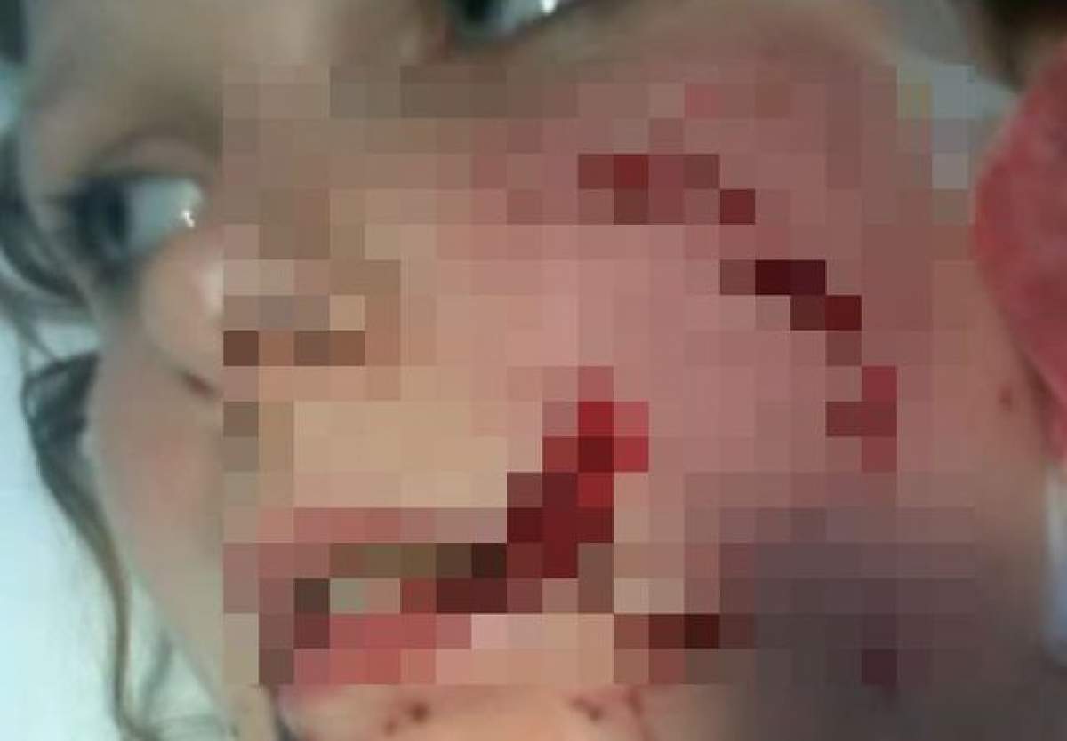 VIDEO/ S-a întâmplat din nou! O fată de 12 ani, desfigurată de câinele unui prieten