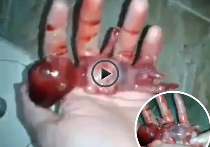 VIDEO ŞOCANT / Un medic a filmat fătul scos dintr-un avort şi era viu! Imaginile care vor schimba percepţia lumii