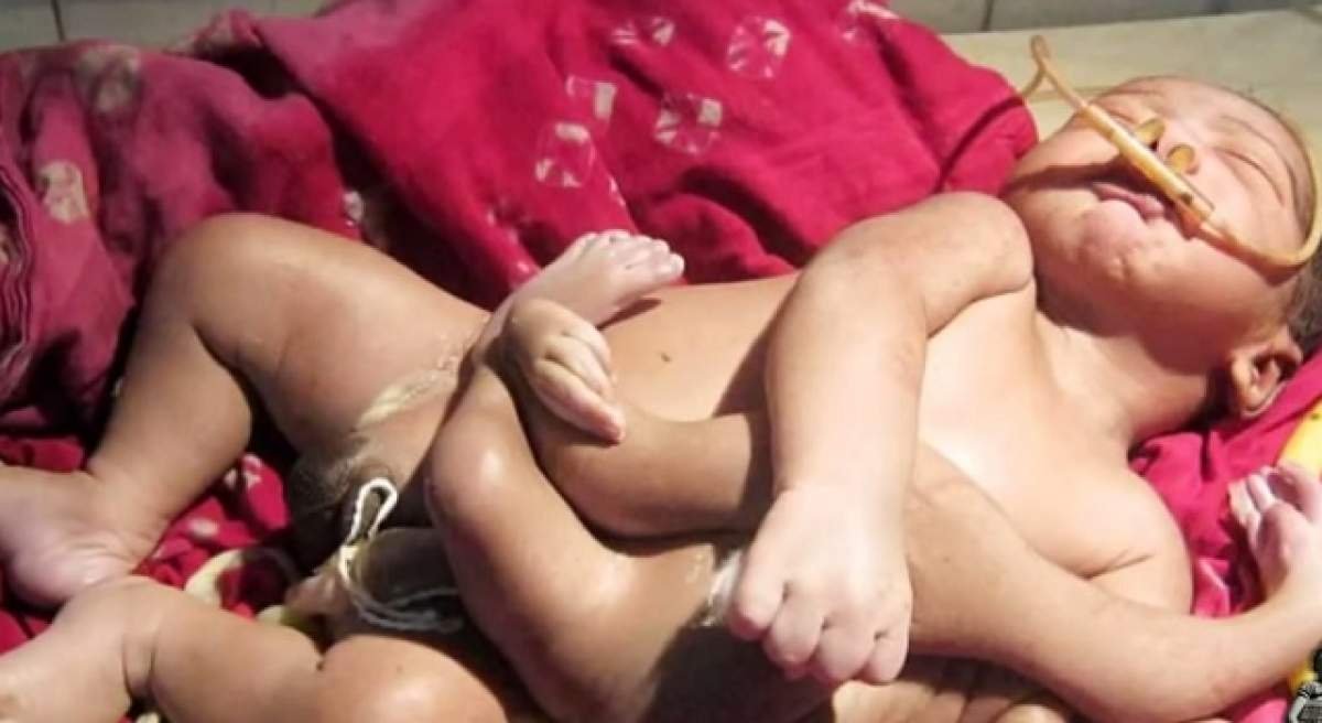VIDEO / El este băiatul tarantulă! Cum arată copilul cu patru mâini şi patru picioare