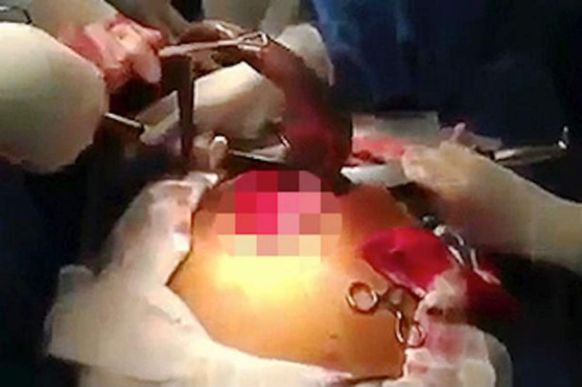 VIDEO / 18 + Medicii au scos din intestinele lui un PEŞTE! Cum a fost posibil aşa ceva?