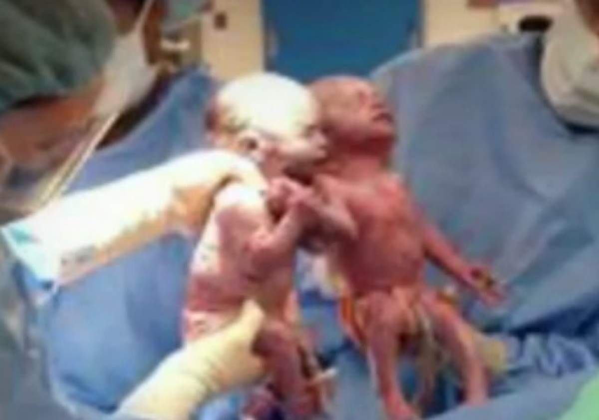 VIDEO/ S-au născut ţinându-se de mână! Se întâmplă o dată la 10.000 de naşteri