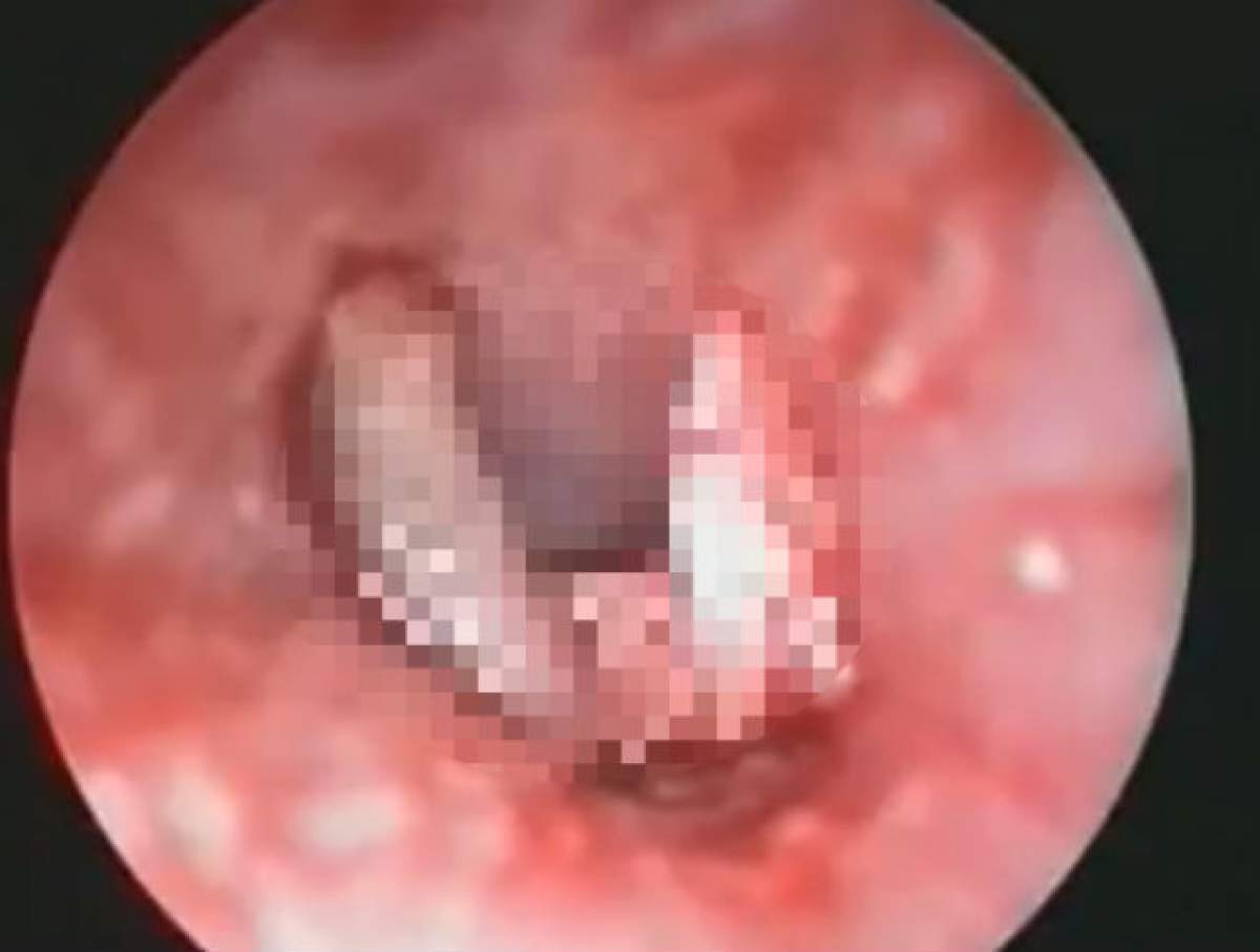 VIDEO Pare imposibil! Ai stomacul tare? Medicii au paralizat de scârbă când au descoperit aşa ceva în urechea unei femei