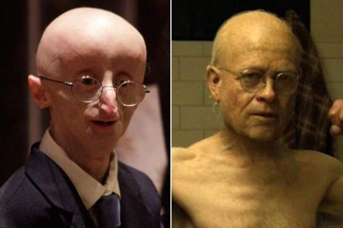 A inspirat personajul Benjamin Button, interpretat de Brad Pitt. Copilul care suferea de bătrâneţe a murit la vârsta de 13 ani