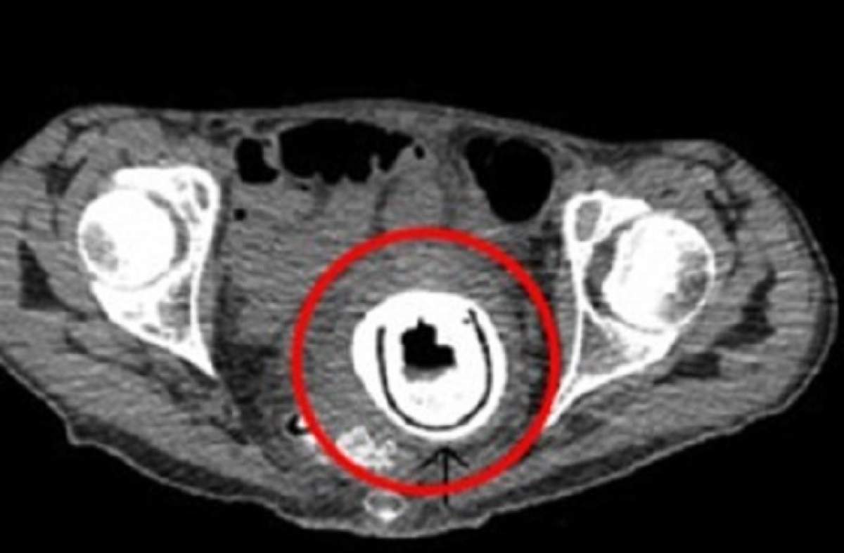 Şocant! Ce au descoperit medicii în vaginul unei femei! Era acolo de 10 ani