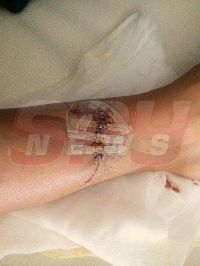 Atenţie, imagini şocante şi necenzurate cu cicatricea Biancăi Drăguşanu! Cum arată piciorul ei după ce medicii s-au chinuit 4 ore ca să-l "repare"