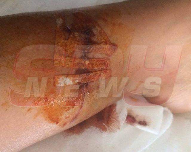 Atenţie, imagini şocante şi necenzurate cu cicatricea Biancăi Drăguşanu! Cum arată piciorul ei după ce medicii s-au chinuit 4 ore ca să-l "repare"