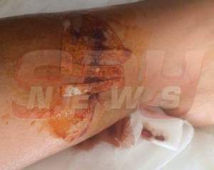 Atenţie, imagini şocante şi necenzurate cu cicatricea Biancăi Drăguşanu! Cum arată piciorul ei după ce medicii s-au chinuit 4 ore ca să-l "repare"