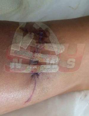 Atenţie, imagini şocante şi necenzurate cu cicatricea Biancăi Drăguşanu! Cum arată piciorul ei după ce medicii s-au chinuit 4 ore ca să-l "repare"