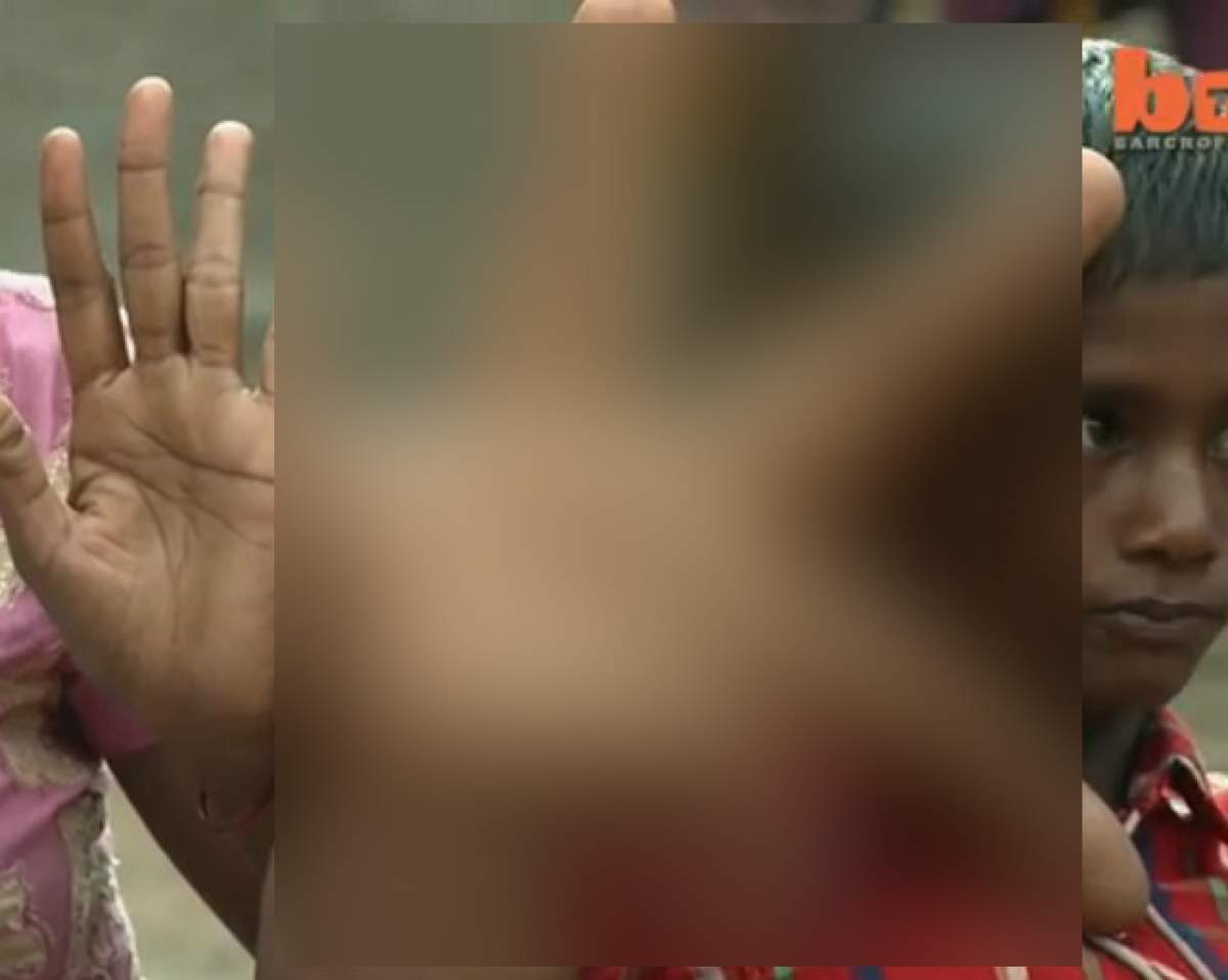 VIDEO /  Imagini GROAZNICE! Copilul care are mâinile mai mari decât capul
