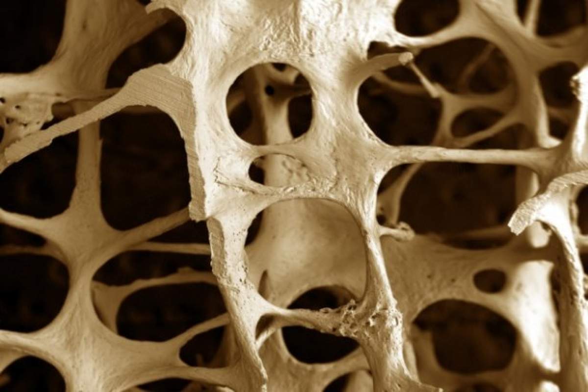 Tratamente eficiente împotriva osteoporozei şi ce să mananci pentru a evita sau ameliora boala