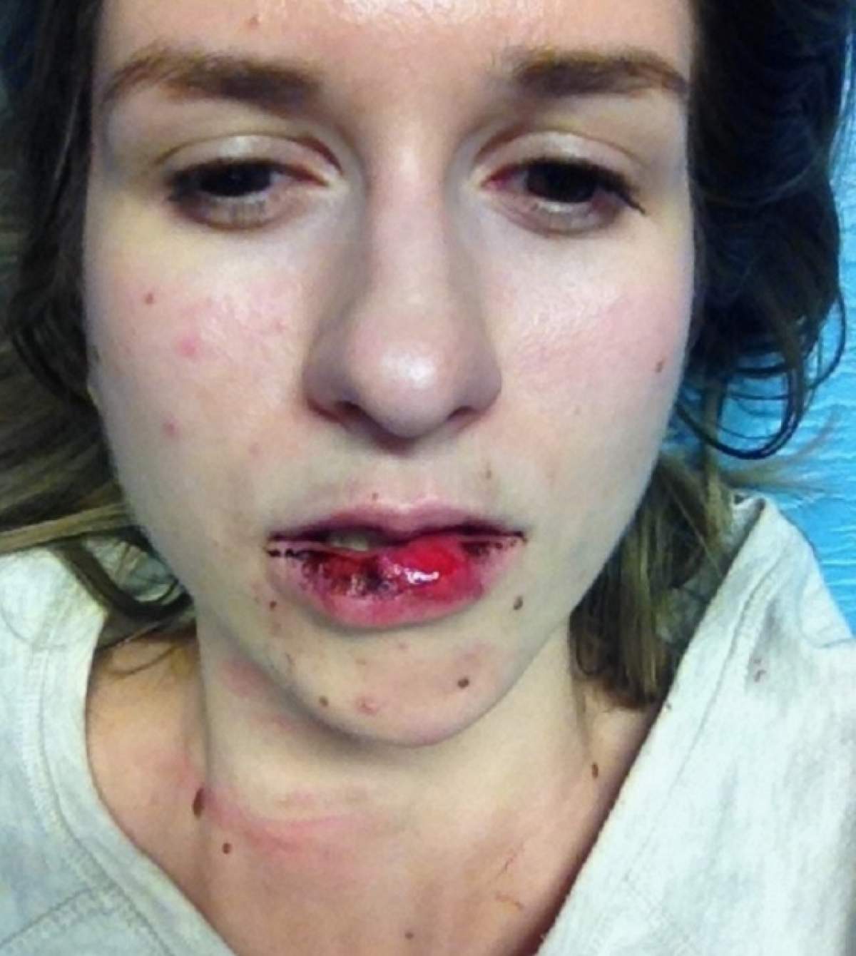 INCREDIBIL Tânără desfigurată de un taximetrist din Bucureşti!  "Mi-a tras un pumn în gură și m-a dat cu capul de asfalt"