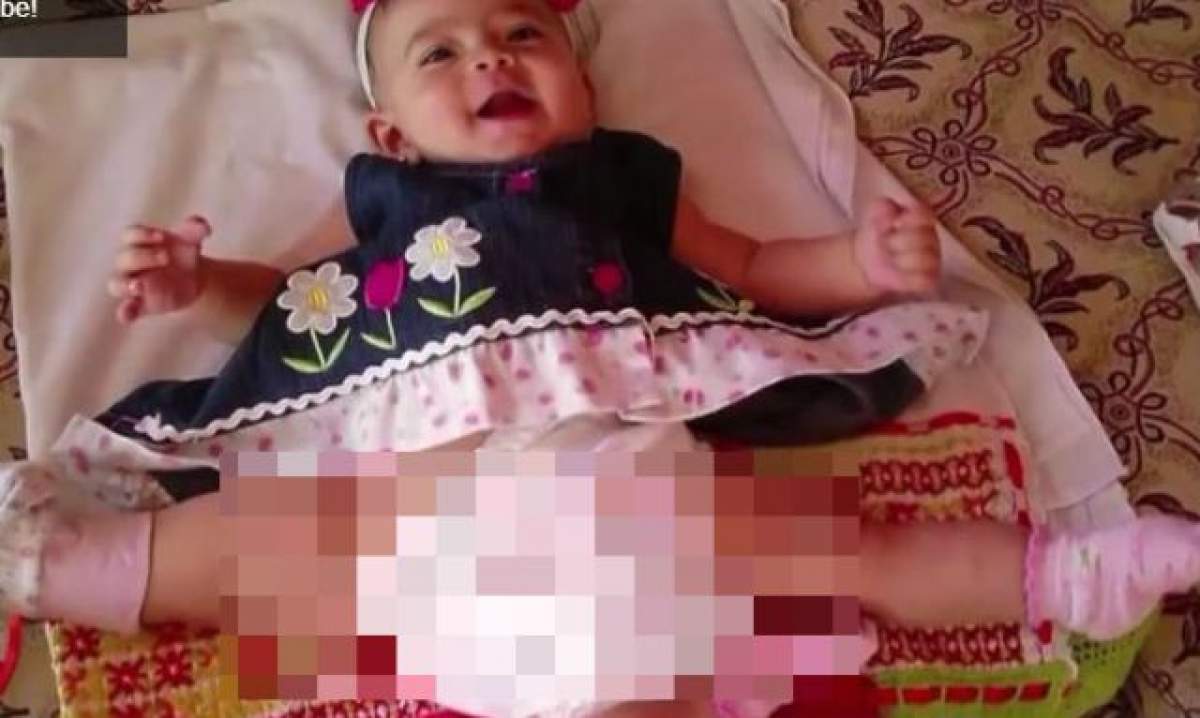 VIDEO / Şocant! O fetiţă a rămas cu 3 picioare după ce a fost separată de sora ei geamănă
