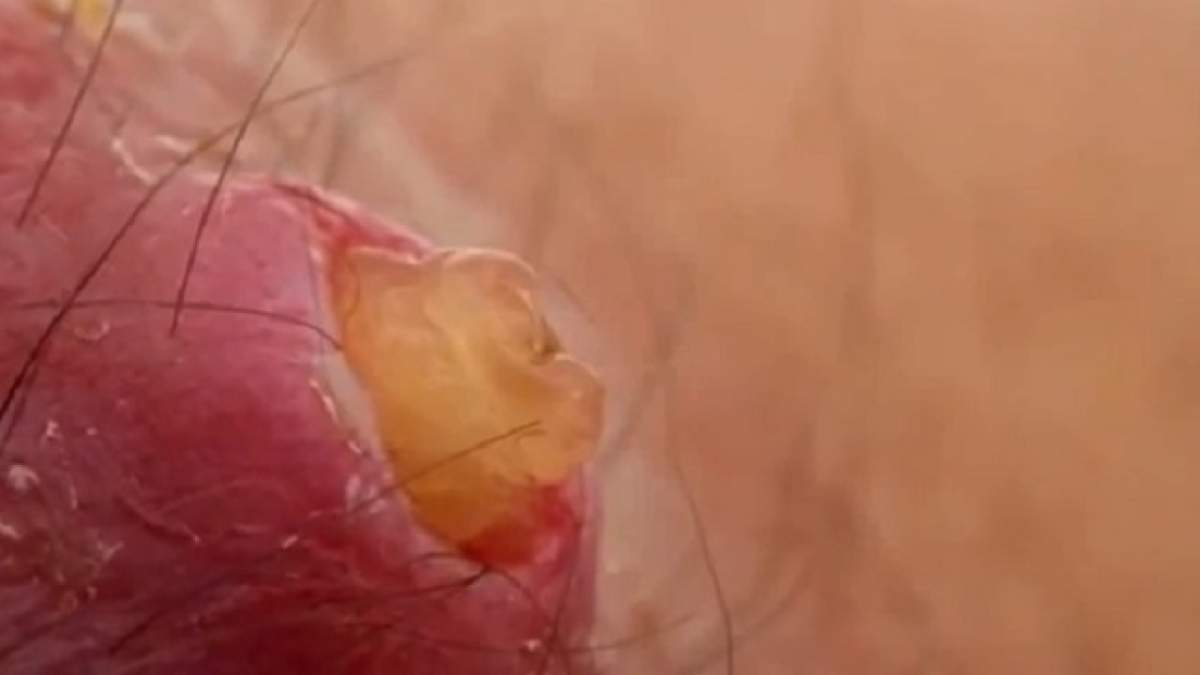 VIDEO / L-a muşcat un gândac! Ce i-a ieşit de sub piele e greu de imaginat