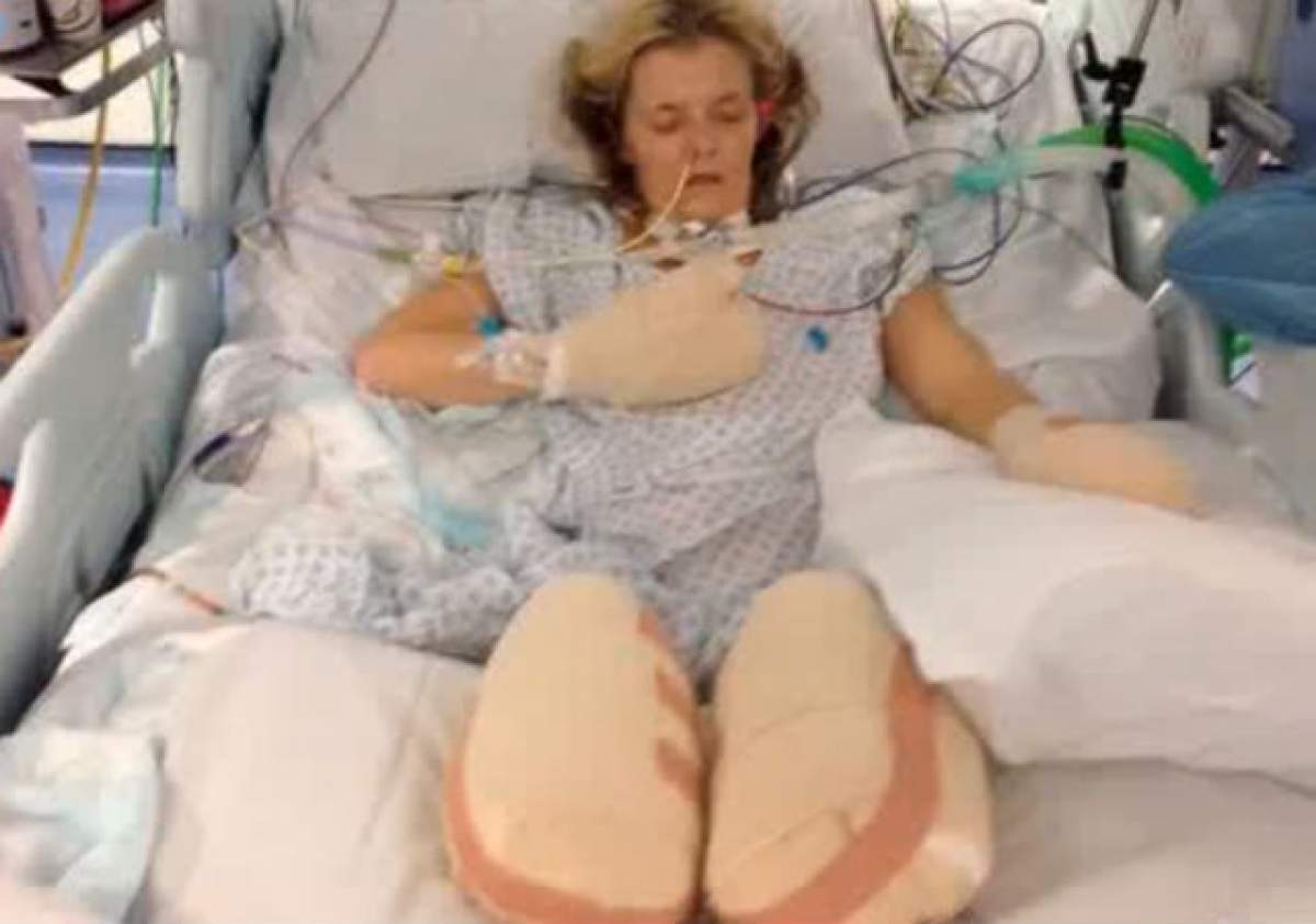 VIDEO ŞOCANT / I-au fost amputate picioarele şi degetele de la mâini, după ce a fost diagnosticată cu pneumonie