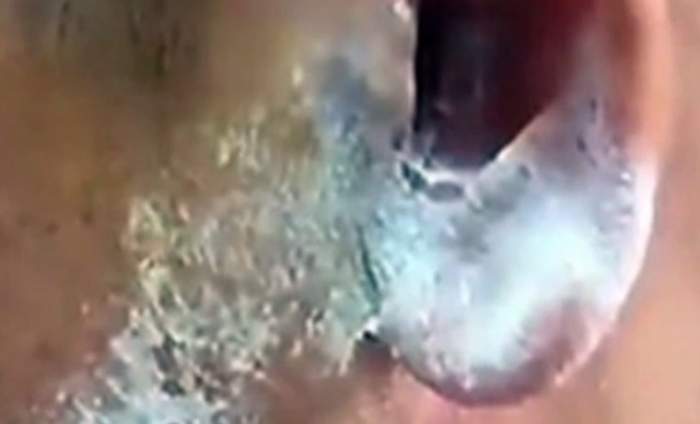 VIDEO / A confundat tubul de superglue cu picăturile pentru infecţie şi a pus lipiciul în ureche. Ce a urmat