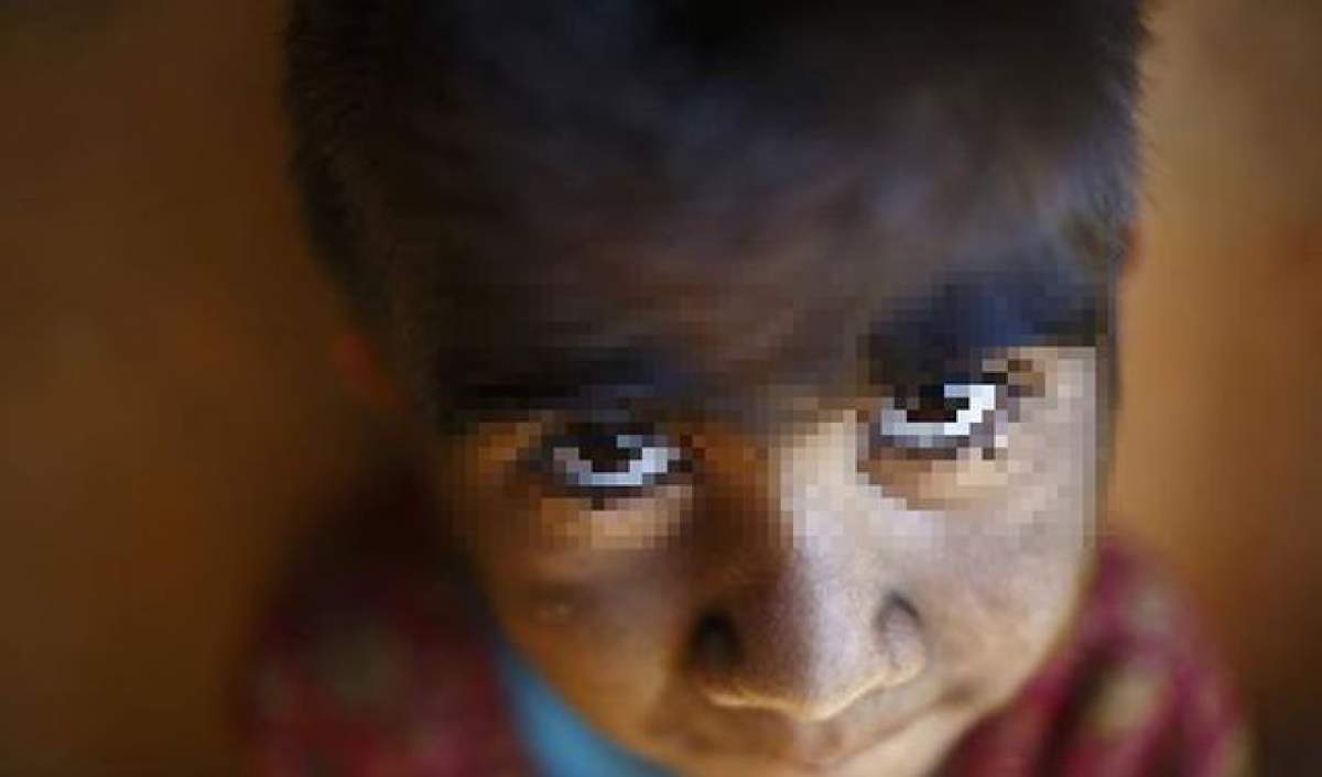 Poveste cutremurătoare! O fetiţă din Nepal suferă de o boală extrem de rară care o face să semene cu un vârcolac