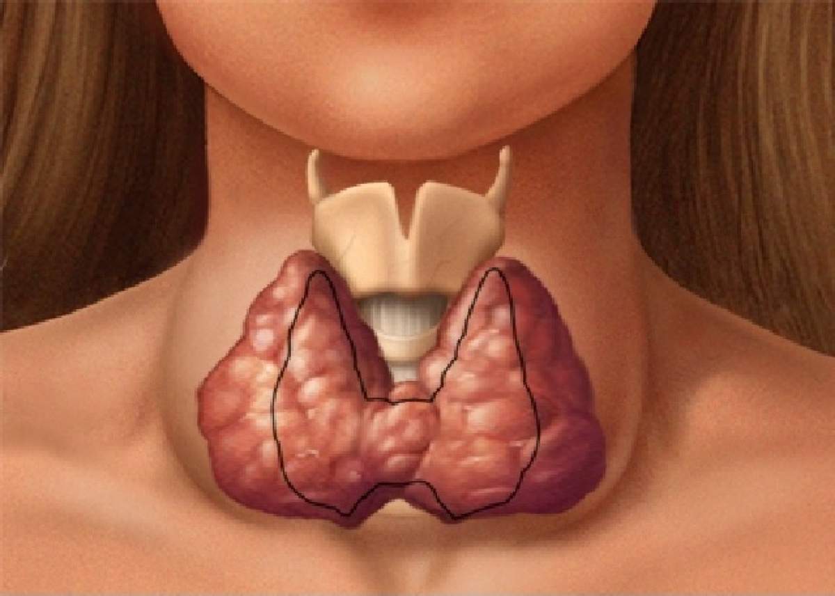 Ai probleme cu glanda tiroidă? Există un tratament care face minuni. Ai și tu ingredientele în bucătărie!