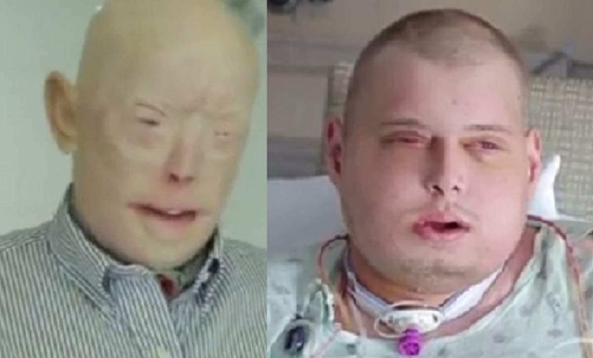 VIDEO / El este bărbatul care a suferit cel extins transplant de faţă! Transformarea pompierului a durat 14 ani