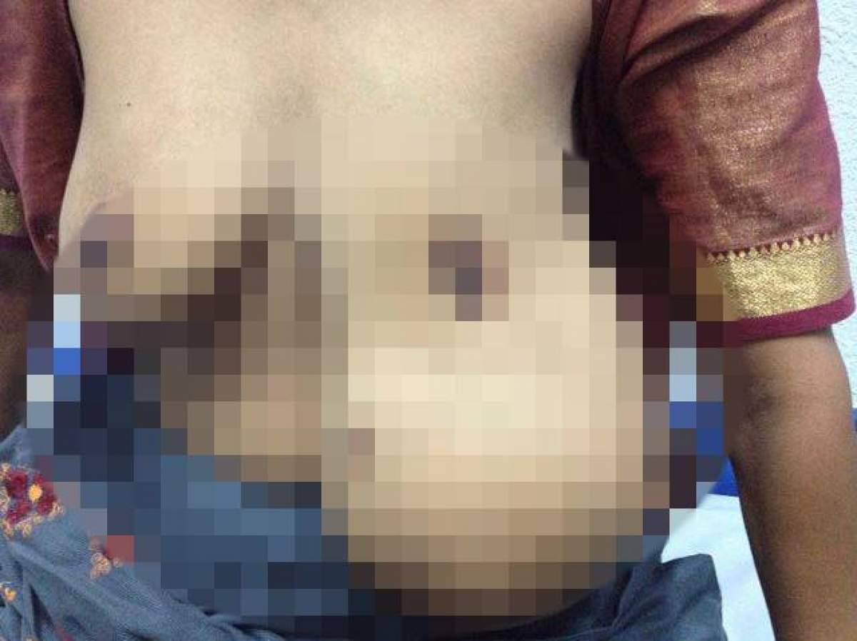 FOTO / Imagini șocante! O femeie s-a născut cu trei sâni, așa că a mers să se opereze! Ce au descoperit medicii e înfiorător