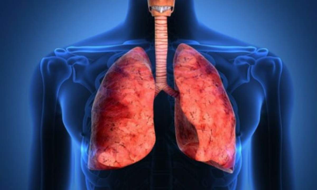 ATENŢIE fumători! Semnul BANAL care vă ajută să depistaţi CANCERUL pulmonar în stadiul INCIPIENT