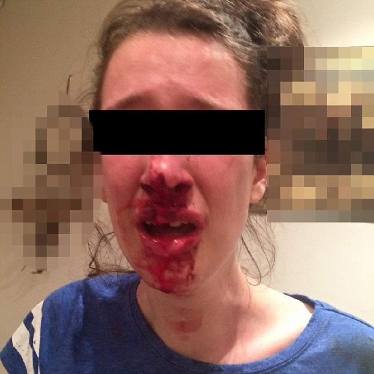 ŞOCANT! I-a spart nasul şi i-a fisurat un dinte! Fotografiile au fost postate pe facebook. Scuza agresorului: "A căzut pe scări"