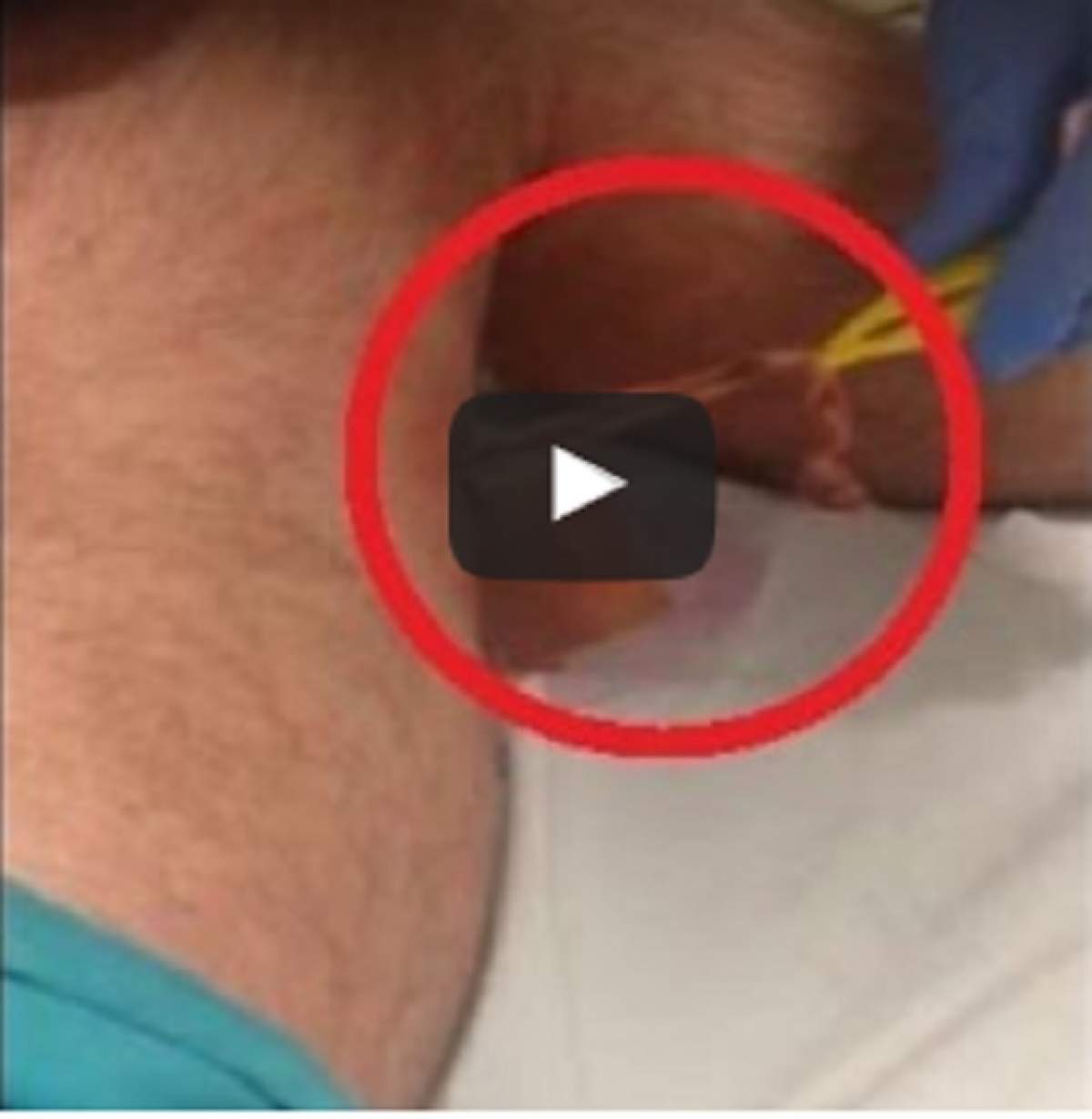 VIDEO / Dezgustător! Ţi se face părul măciucă! Cum este îndepărtat un păianjen din piciorul unui bărbat