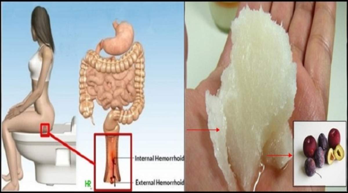 Iată cum poţi vindeca complet hemoroizii sau reduce simptomele acestora pe cale naturistă