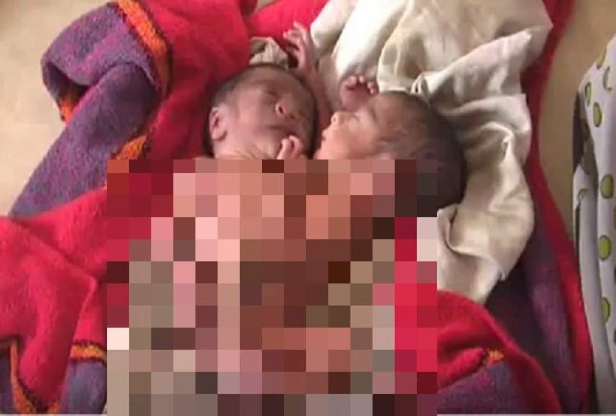 VIDEO / S-a născut copilul cu două capete, patru mâini şi două picioare! Medicii au fost şocaţi când au văzut cum arată