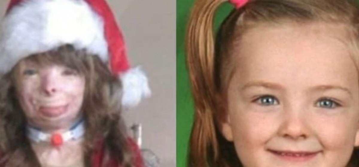 După ce a rămas desfigurată în urma unui accident, o fetiță a avut un singur vis de Crăciun. Vezi dacă i s-a împlinit