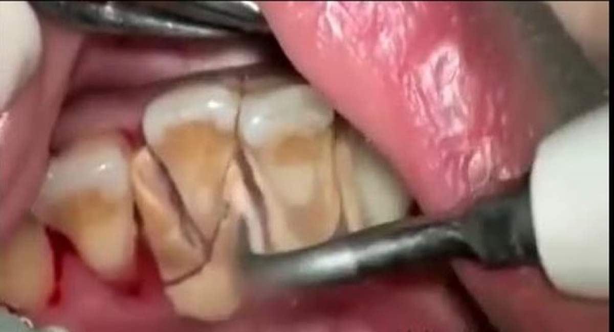 VIDEO / Îngrozitor! Ce se întâmplă în gura ta atunci când nu te speli pe dinţi