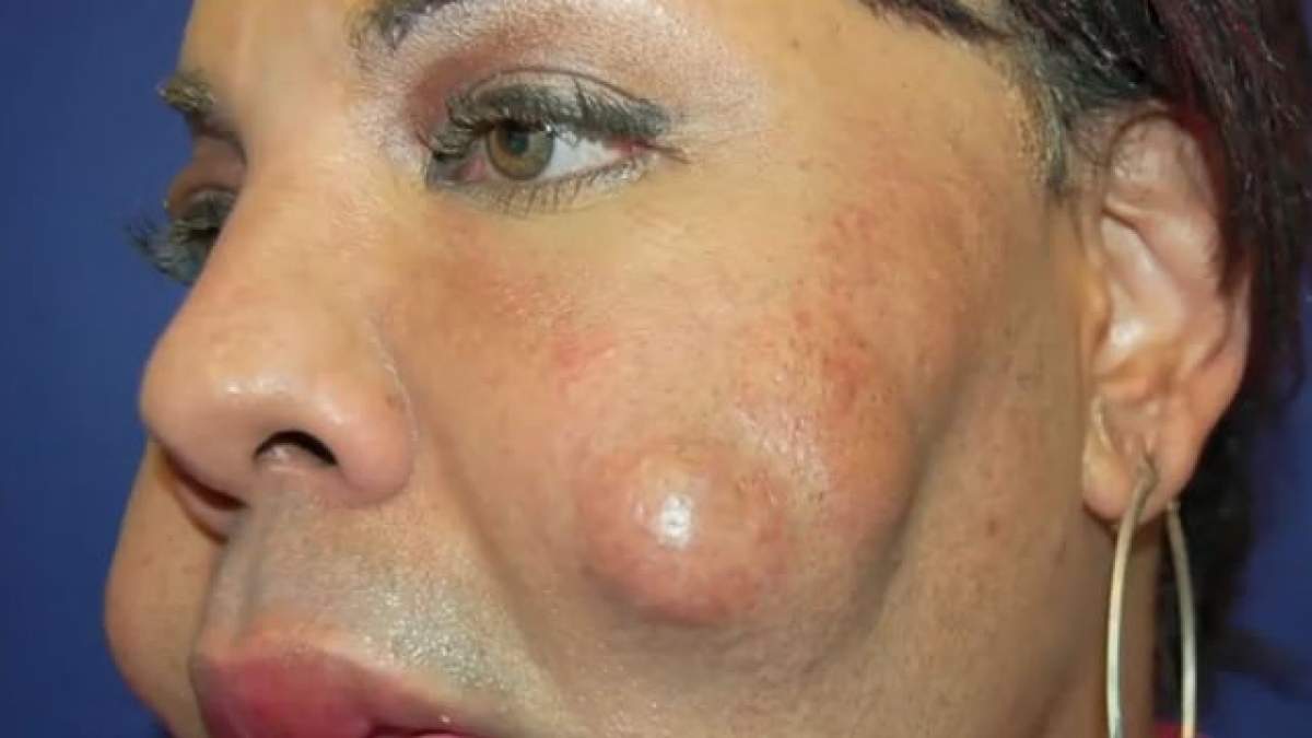 VIDEO/ Şocant! Şi-a injectat timp de 10 ani ciment în faţă din dorinţa de a se transforma în femeie