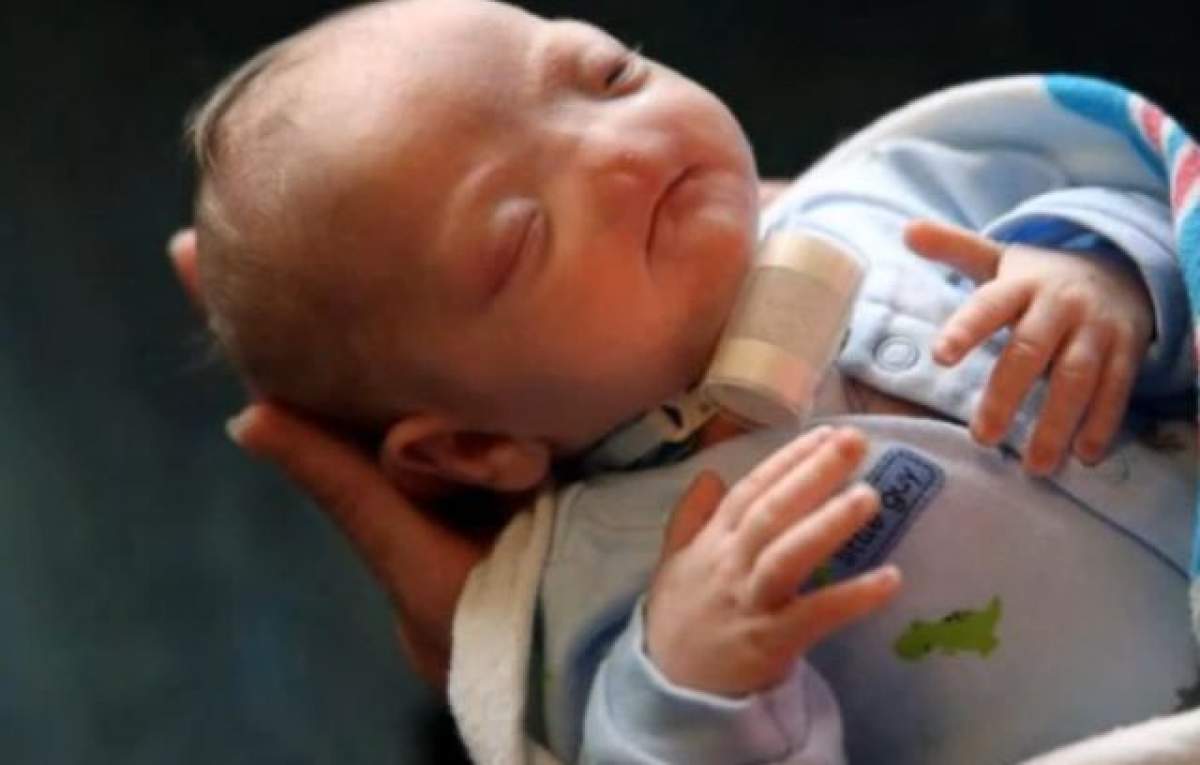 VIDEO / S-a născut fără nas! Cum arată "Bebeluşul Minune"! Se întâmplă o dată la 197 de milioane de naşteri