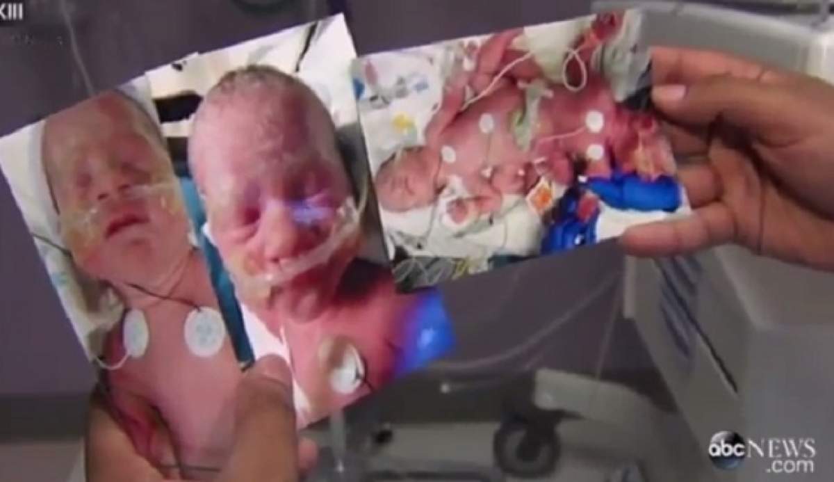 VIDEO / Caz de tripleţi identici extrem de rar! Două corpuri, trei copii